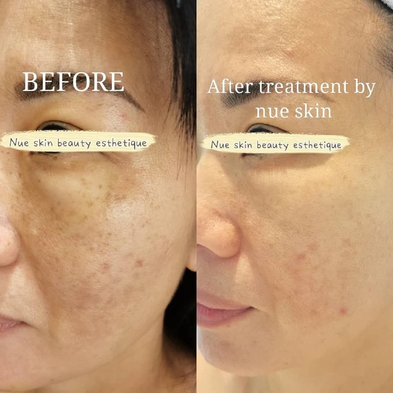 Pigment & Under-Eye Renewal before and after — Nue Skin Beauty Esthetique