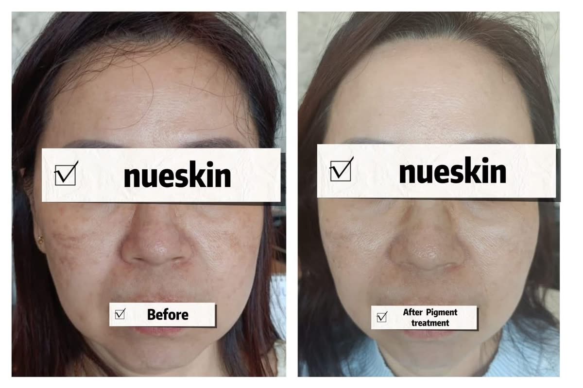 Full face pigmentation and melasma treatment before and after — Nue Skin Beauty Esthetique