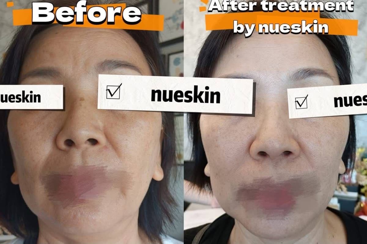 Full face pigmentation and dark spot treatment before and after — Nue Skin Beauty Esthetique