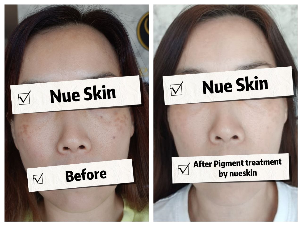 Facial pigmentation treatment before and after — Nue Skin Beauty Esthetique