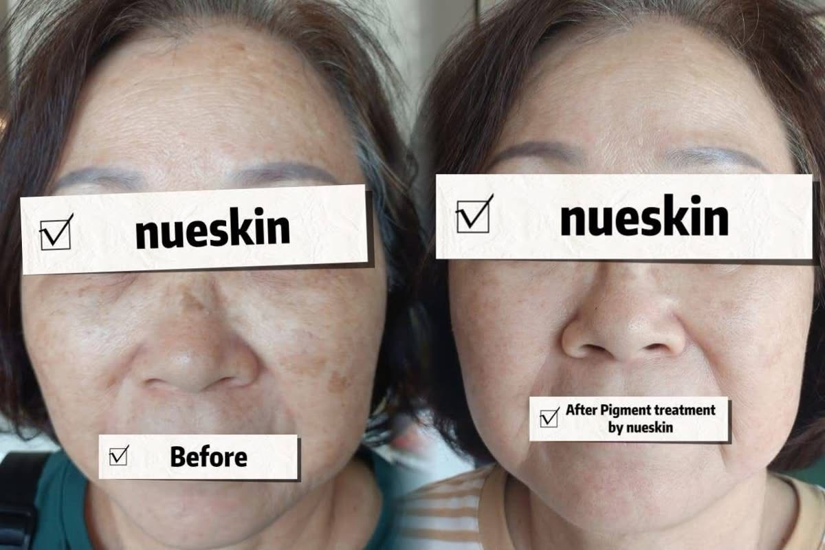 Pigment treatment full face results before and after — Nue Skin Beauty Esthetique