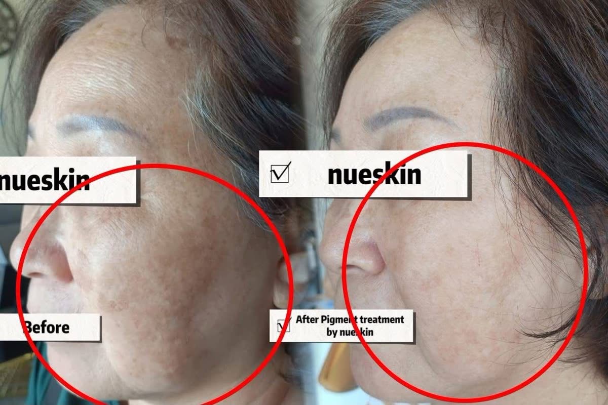 Pigment treatment forehead wrinkles before and after — Nue Skin Beauty Esthetique