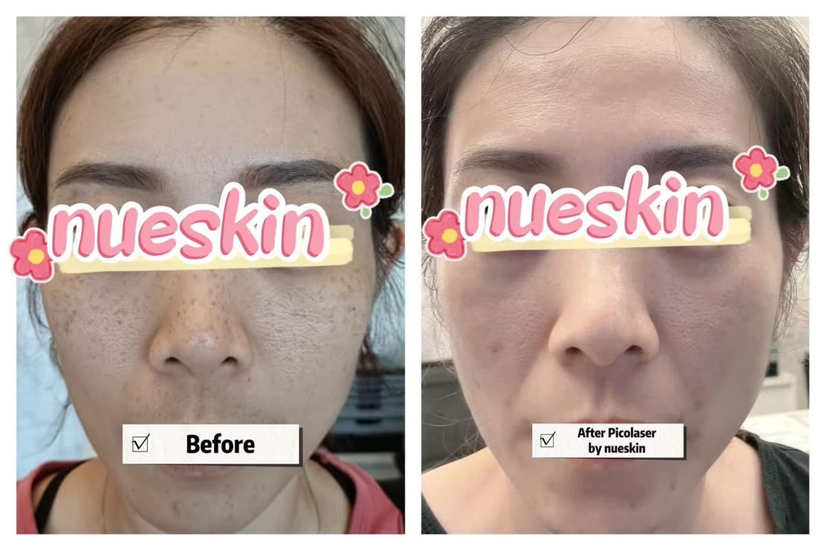Facial freckle and pigment pico laser treatment before and after — Nue Skin Beauty Esthetique