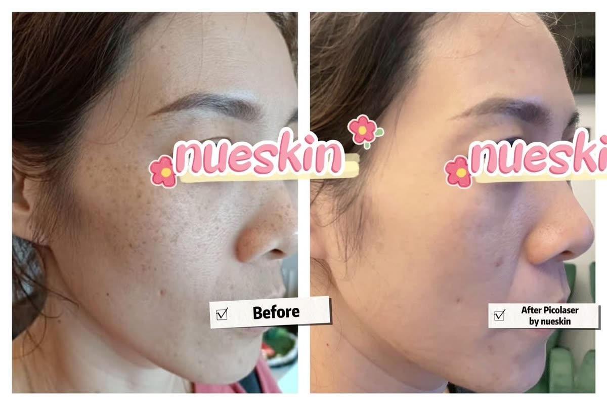 Freckle and sun spot pico laser treatment before and after — Nue Skin Beauty Esthetique