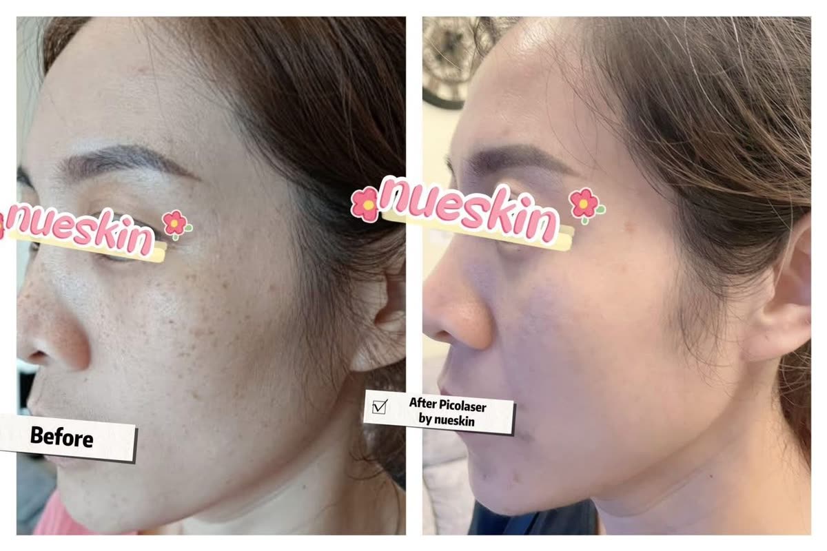 Facial freckle pico laser treatment before and after — Nue Skin Beauty Esthetique