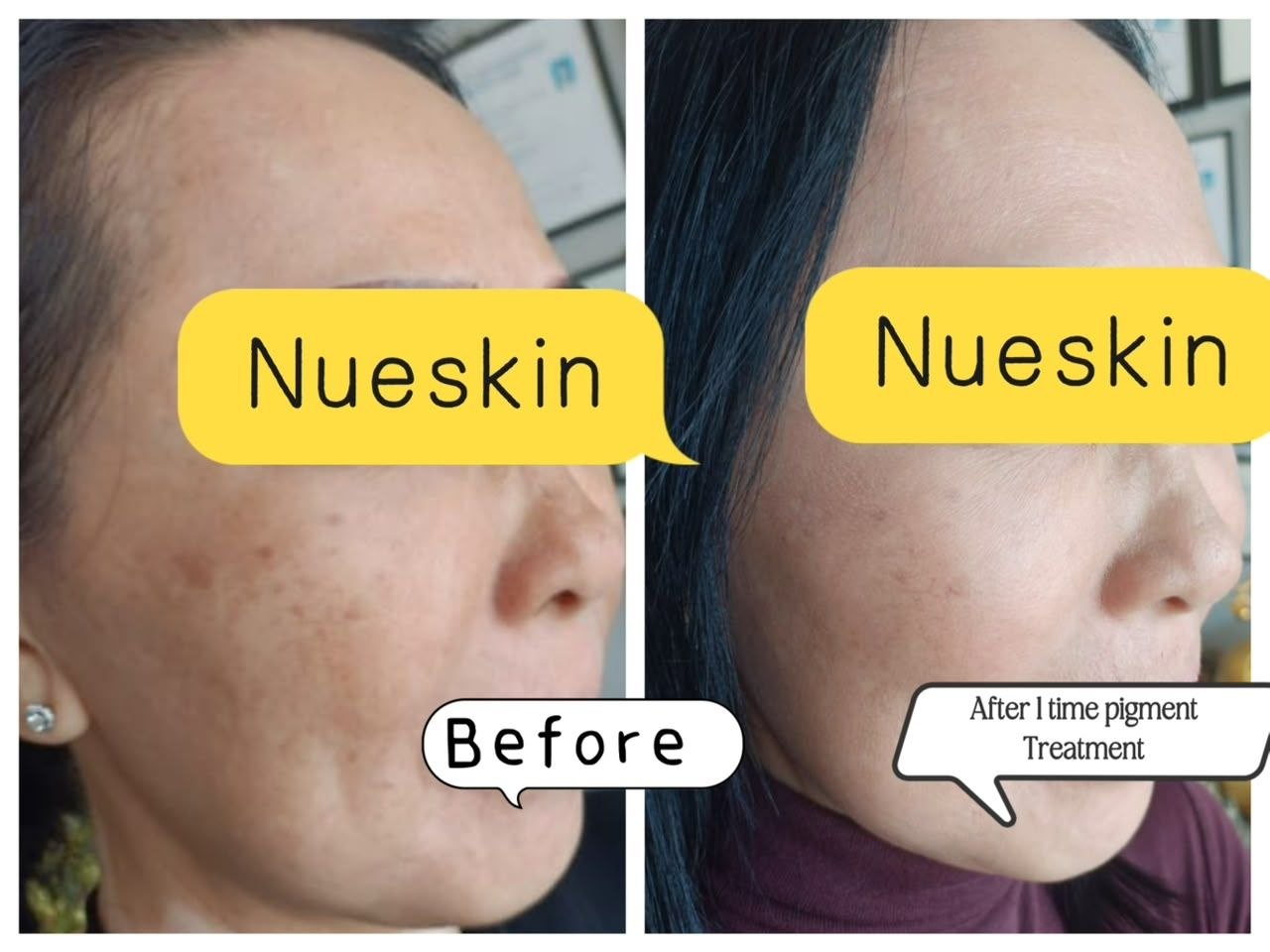 Full-cheek pigmentation and dark spot treatment before and after one session — Nue Skin Beauty Esthetique