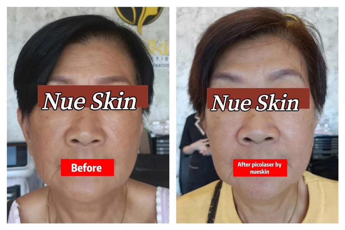 Facial pigmentation pico laser treatment before and after — Nue Skin Beauty Esthetique