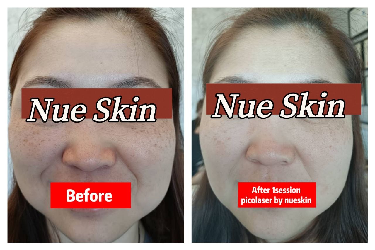 Pico laser pigmentation treatment result after one session — Nue Skin Beauty Esthetique