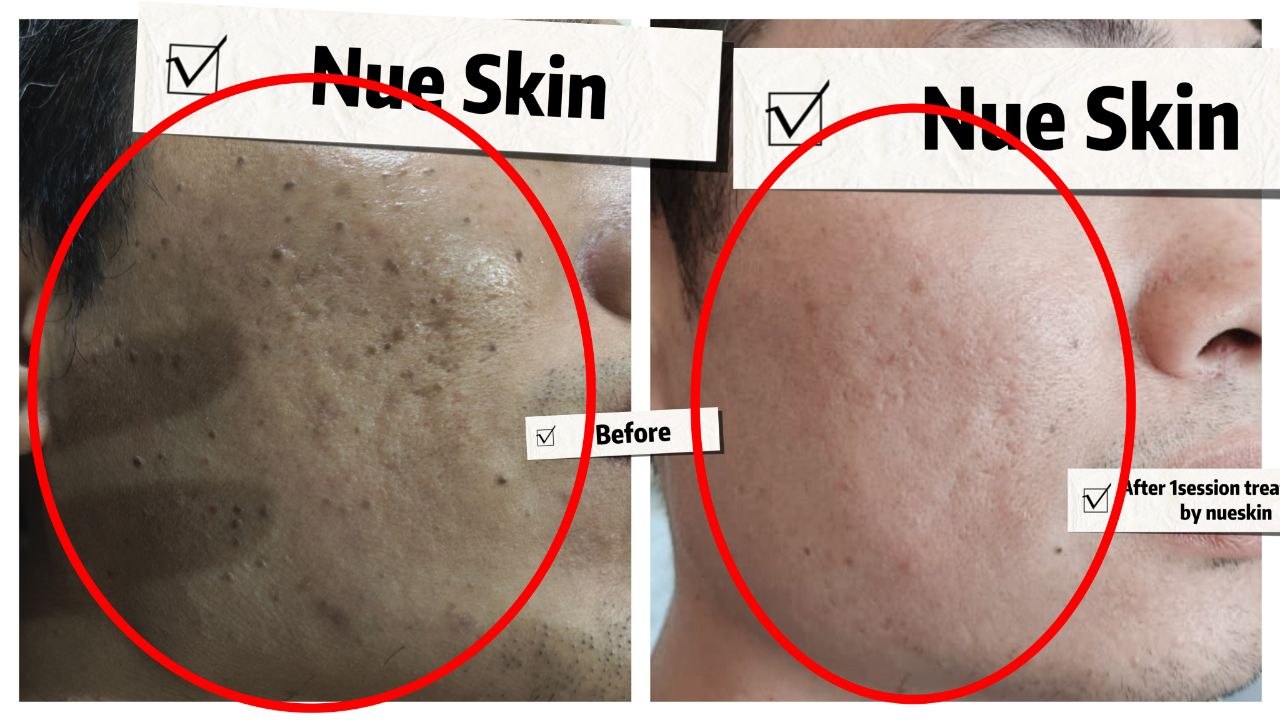 Dense dark spot and pigmentation clearing after one session — Nue Skin Beauty Esthetique