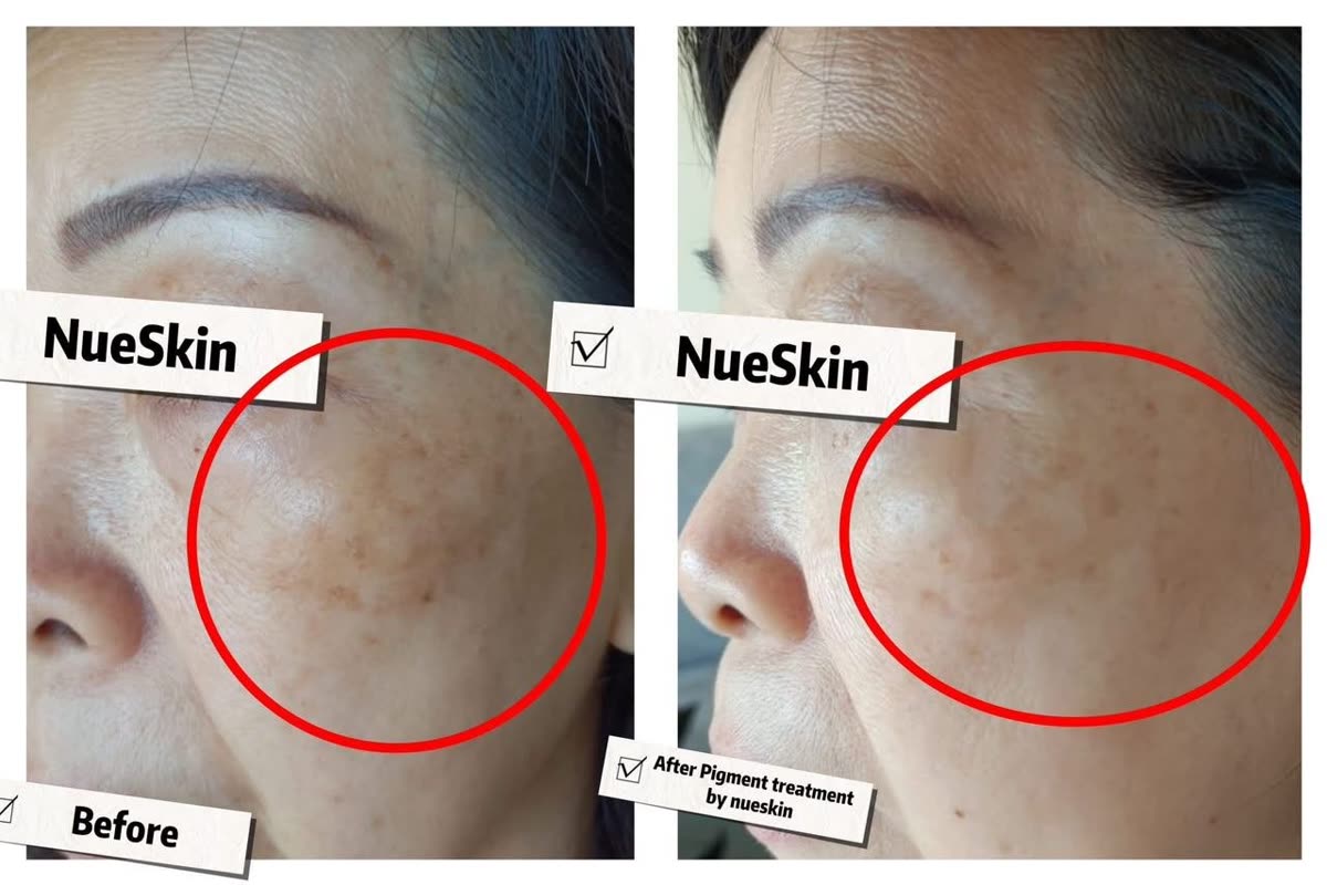 Under-eye and cheek pigmentation treatment before and after — Nue Skin Beauty Esthetique