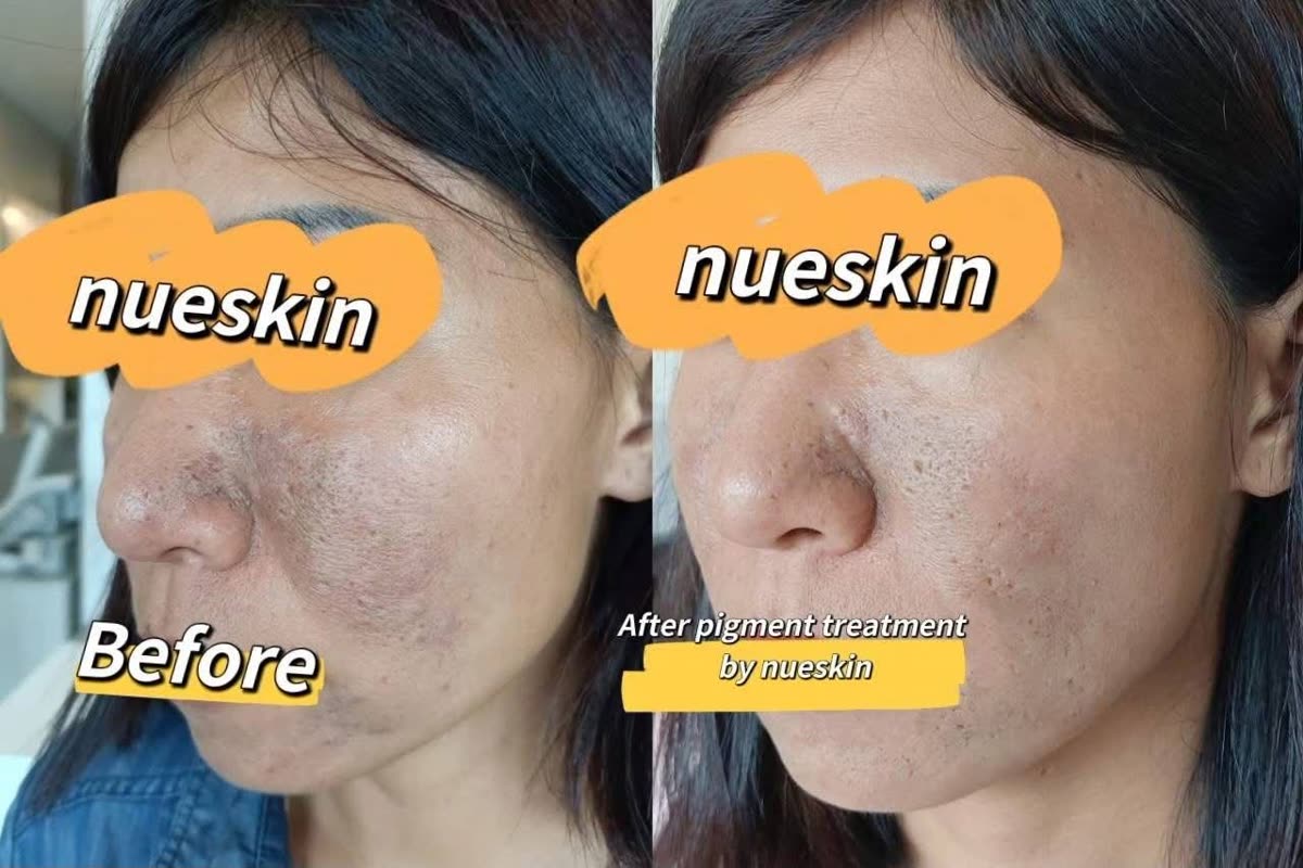 Acne scar and texture treatment on cheek before and after — Nue Skin Beauty Esthetique