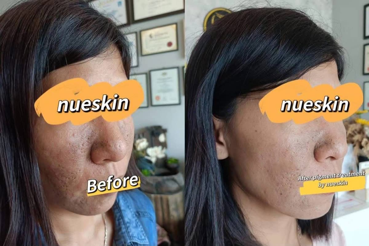 Pitted acne scar resurfacing on cheek before and after — Nue Skin Beauty Esthetique