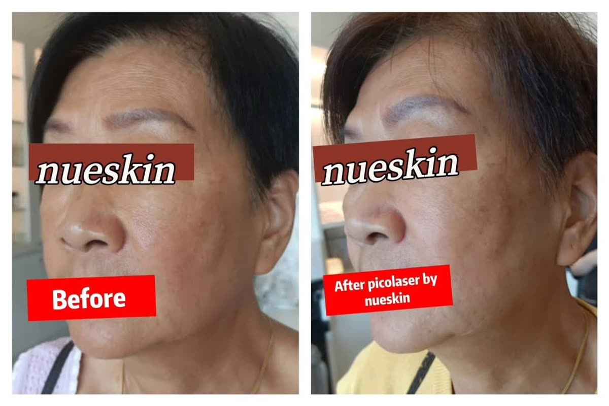 Fotona acne scar treatment on cheek before and after one session — Nue Skin Beauty Esthetique