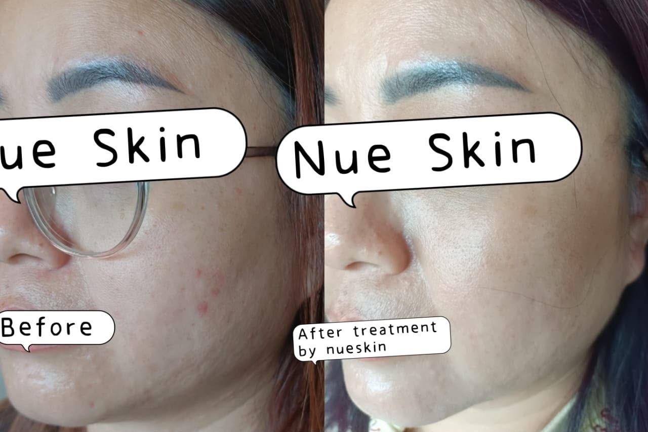 Skin Treatment before and after — Nue Skin Beauty Esthetique