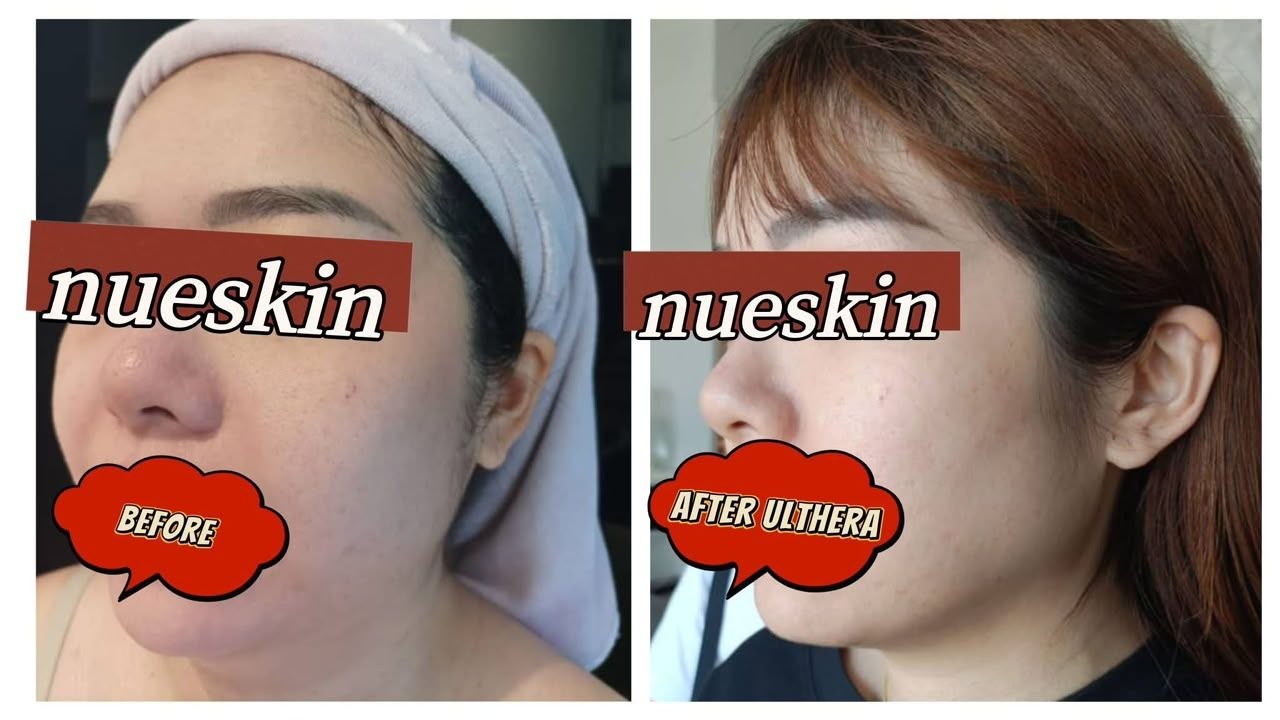 ULTHERA Jaw Contouring before and after — Nue Skin Beauty Esthetique