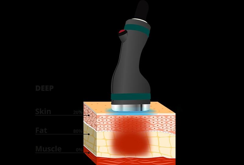 Onda PRO Deep handpiece penetration depth — localized fat deposits on large body areas (skin 20%, fat 80%) — Nue Skin Beauty Esthetique