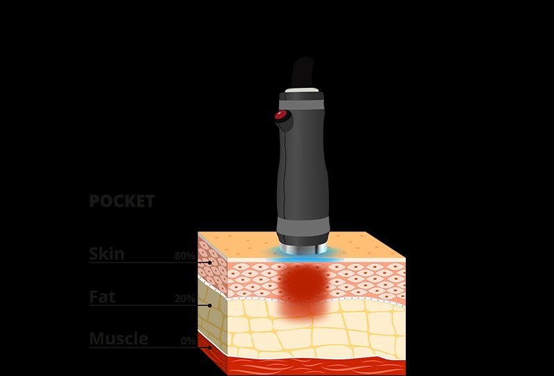Onda PRO Pocket handpiece penetration depth — facial contouring and skin tightening (skin 80%, fat 20%) — Nue Skin Beauty Esthetique