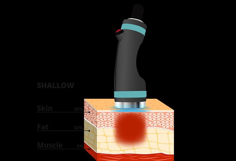 Onda PRO Shallow handpiece penetration depth — cellulite, skin laxity and submental areas — Nue Skin Beauty Esthetique
