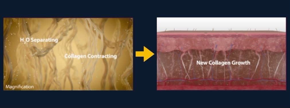 Thermage collagen remodeling mechanism — microscopic magnification of water separating and collagen contracting, then new collagen growth after treatment — Nue Skin Beauty Esthetique