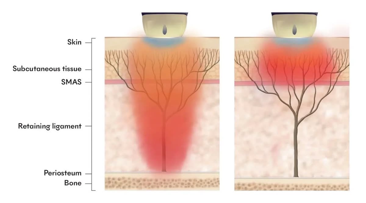 Titanium laser penetration depth diagram — deeper stacking energy for lifting versus shallower sweeping energy for surface brightening across the skin, SMAS and ligament layers — Nue Skin Beauty Esthetique