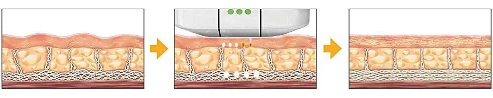 Ultherapy collagen infusion process diagram — lax skin, focused ultrasound energy being delivered, and regenerated firmer collagen after treatment
