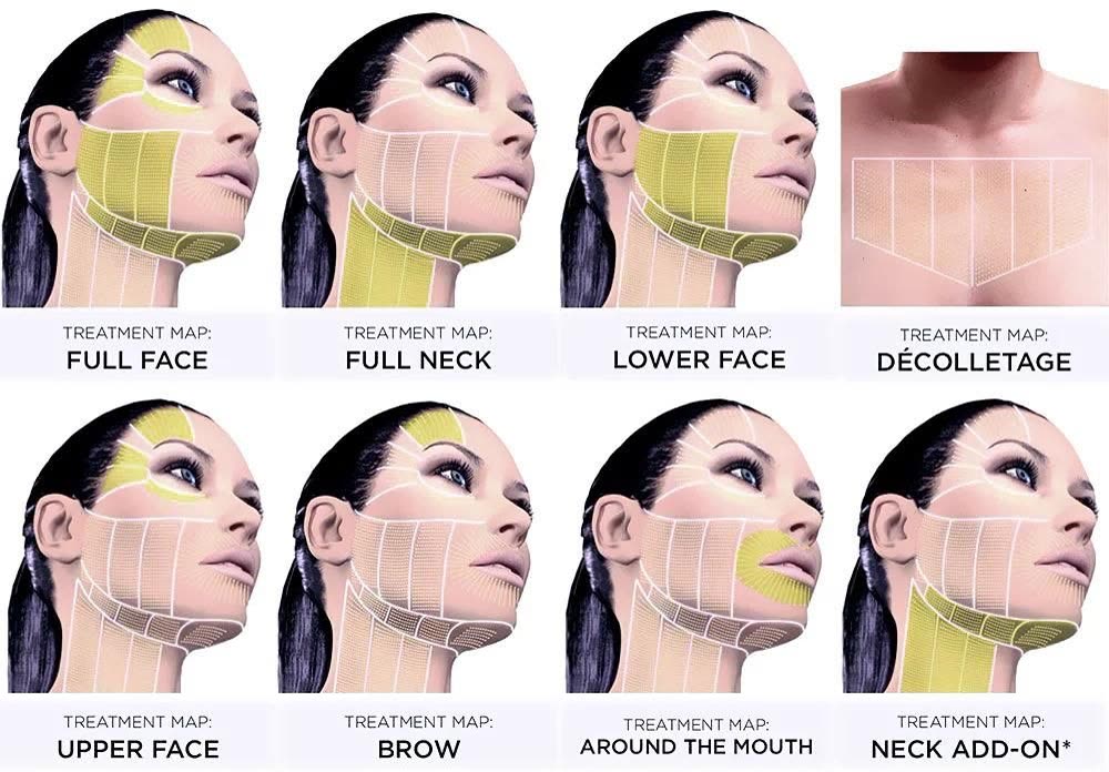 Ultherapy HIFU treatment area maps — full face, full neck, lower face, décolletage, upper face, brow, around the mouth and neck add-on